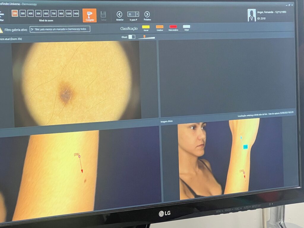 como é realizado o exame de dermatoscopia digital
