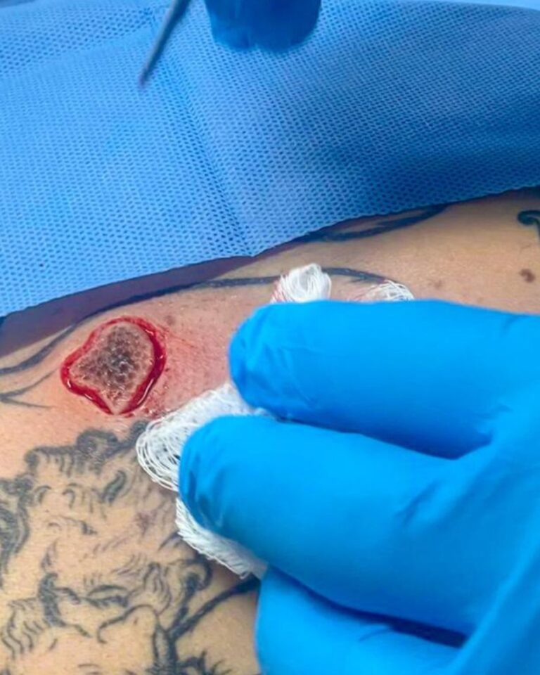 dermatoscopia digital e cirurgia especialista em melanoma dr tovo luis fernando