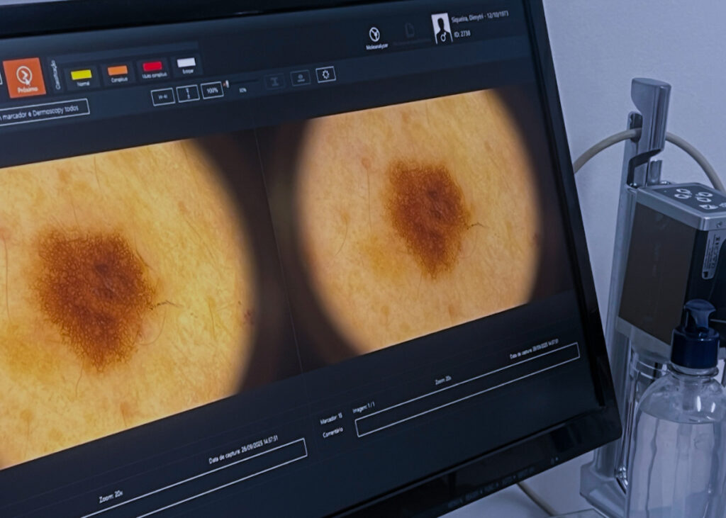 cirurgia cancer da pele e melanoma dr tovo hospital sirio libanes