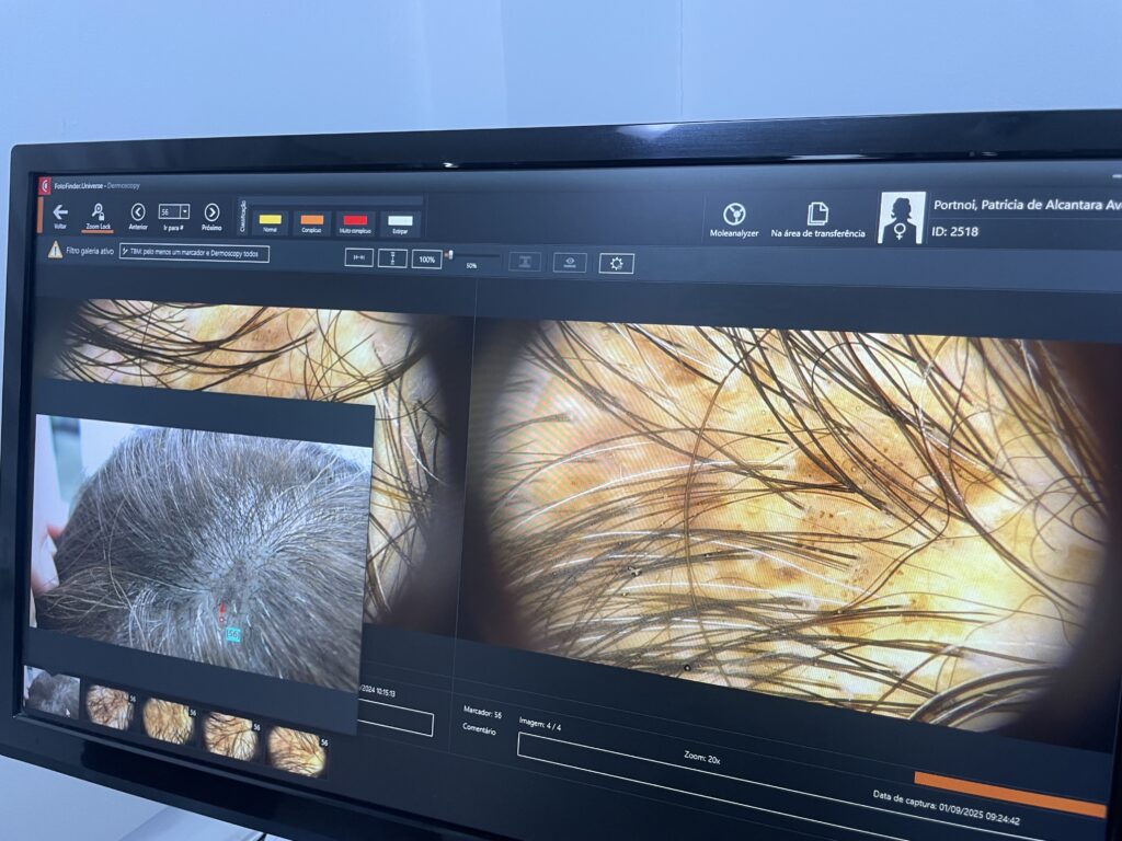 foto dermatoscopia dr tovo luis fernando tovo dermatologista