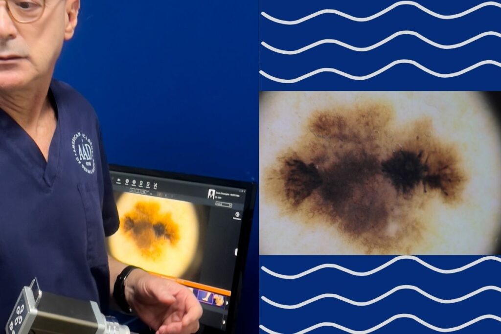 diagnostico precoce câncer de pele dr. tovo dermatologista alameda campinas 745