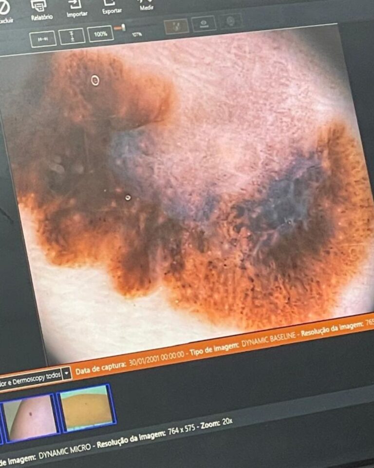foto de câncer de pele e melanoma dr tovo Luis Fernando Tovo dermatologista no sirio libanes