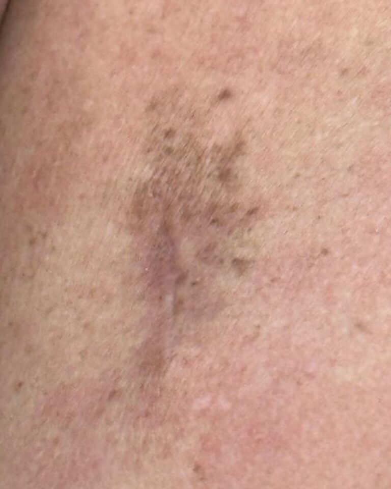 foto de câncer de pele dr tovo luis fernando tovo especialista