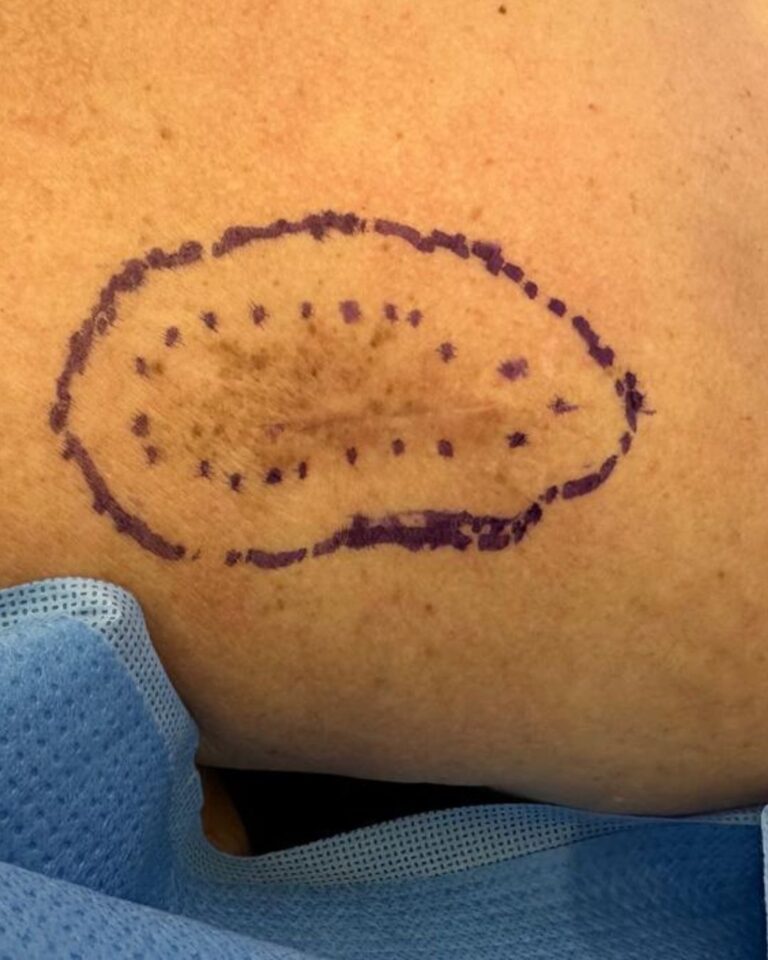 foto de câncer de pele melanoma dr tovo Luis Fernando Tovo dermatologista no sirio libanes 3