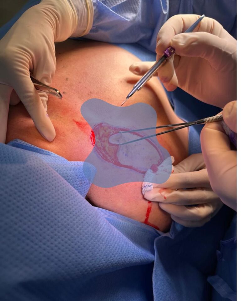 foto de melanoma cirurgico dr tovo Luis Fernando Tovo dermatologista